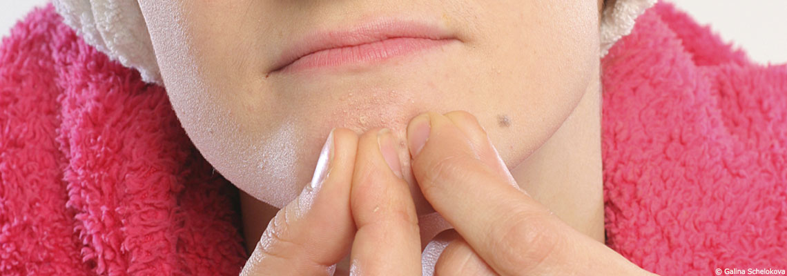 L’acné : comment y faire face ?