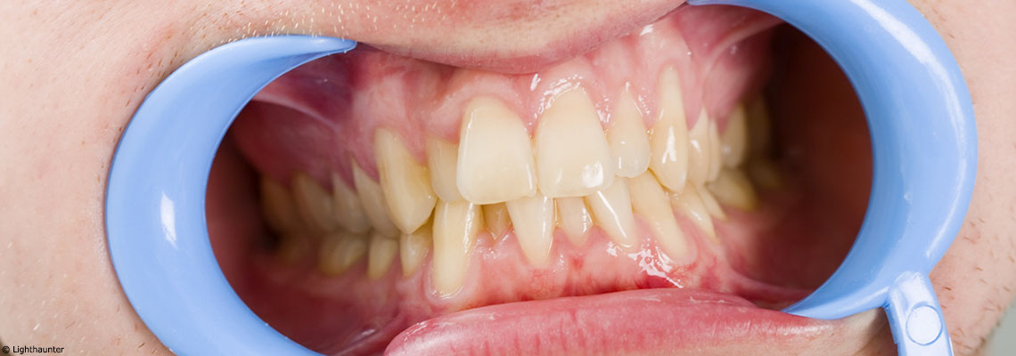 Chercher l'origine des maladies du côté des dents…